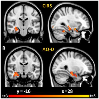 Neural Correlates of Anosognosia in Alzheimer's Disease and Mild Cognitive Impairment: A Multi-Method Assessment